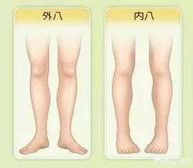 走路外八字的男人视频:宝宝走路有点外八字怎么纠正？