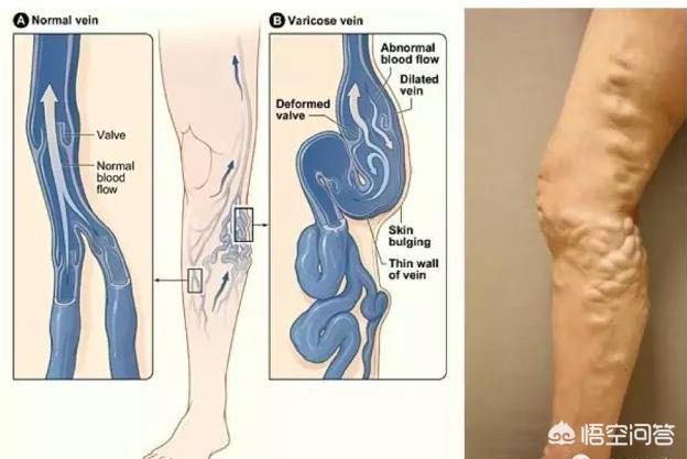 静脉曲张的消炎药有哪些:静脉曲张的消炎药有哪些 静脉曲张是不是血管堵塞了，谢谢哦？