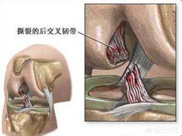 剧烈运动后韧带拉伤怎么办:韧带拉伤能剧烈运动吗 什么运动可以帮助膝盖韧带损伤恢复？