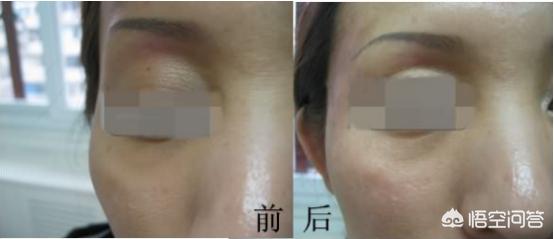 颞部填充,什么是自体脂肪丰太阳穴？