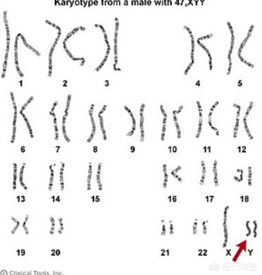 美人鱼综合征的特征，一个人的Y染色体变短，会不会引起性格上的变化