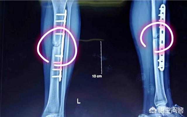 头条问答 胫骨在骨折术后一年都没有愈合 走路还是瘸以后能正常走路吗 想好好做医生的胖子的回答 0赞