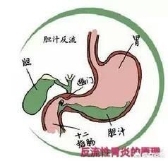 胆汁胃炎的症状及治疗:胆汁反流性胃炎并伴有重度萎缩、肠化，有什么好的治疗方法呢？