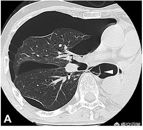 头条问答 肺大泡的症状有哪些 应该如何治疗 27个回答