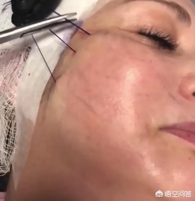 因为眼部有细纹开始用眼霜，结果开始长脂肪粒，该怎么办