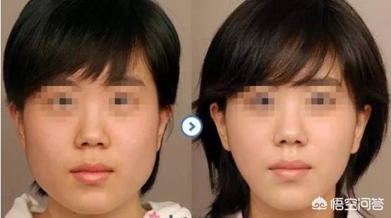 刘涛打瘦脸针面部凹陷，为什么有些人喜欢打瘦脸针和玻尿酸？