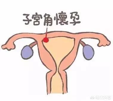 孕囊位于子宫中段影响大不大-孕囊位于宫腔中段在哪个位置