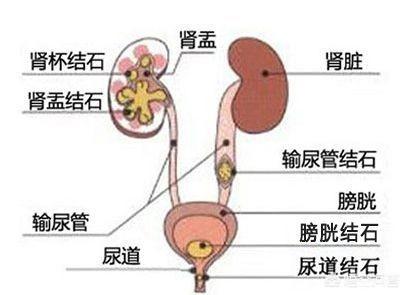 膀胱结石症状预防:肾结石或尿道结石有什么症状？