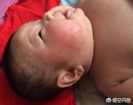 如何鉴别孩子起的是湿疹还是痱子，为什么有的宝宝身上忽然起了红点点
