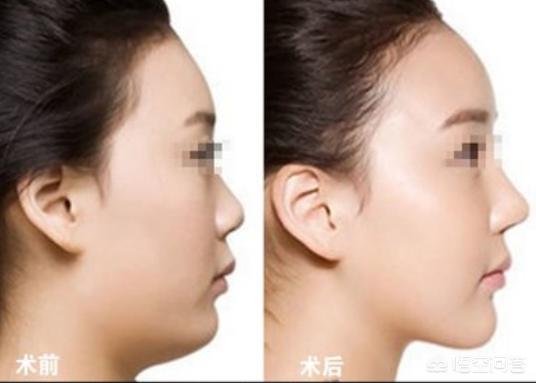 人鼻腔结构图:鼻子的结构是什么样子的？
