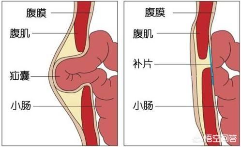 头条问答 - 怎样缓解小孩疝气疼痛?(15个回答)