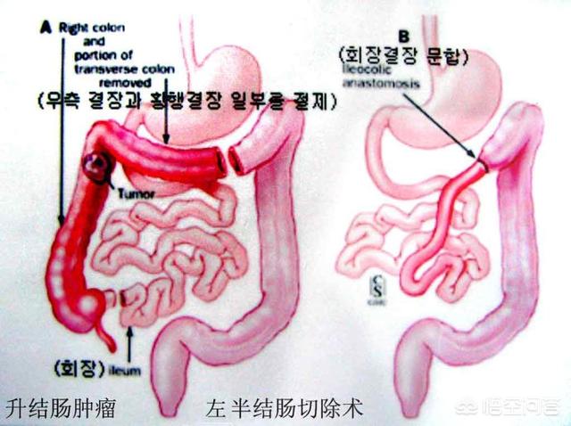 大肠全切以后怎么饮食大肠全切以后怎么饮食