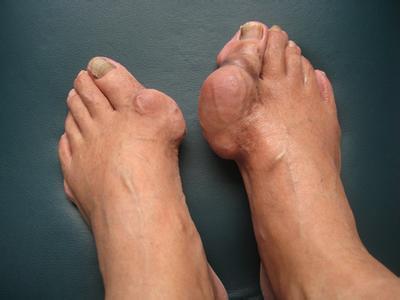 栀子能治痛风吗脚痛风穿什么鞋子最合适