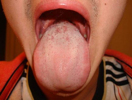 咽炎的症状有哪些(咽炎的症状有哪些症状)