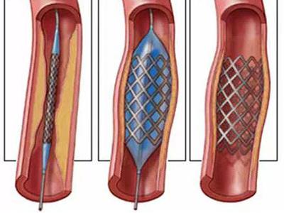 心脏支架手术要多久图片