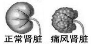 痛风病友微信群:为什么痛风容易引发肾结石？