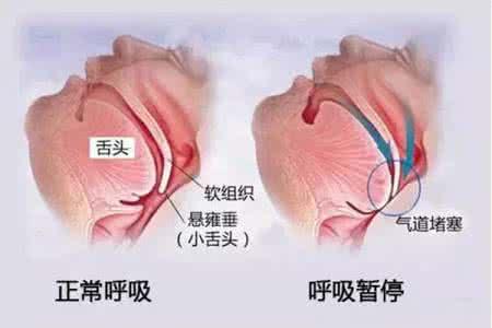 打呼噜的原因:晚上为什么会打呼噜？有什么危害吗？