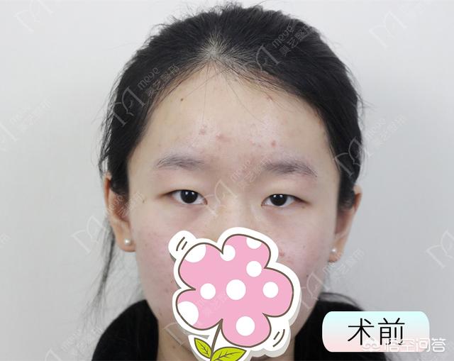 头条问答 你做整容后悔了吗 孔宇医生的回答 0赞