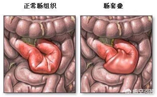 宝宝肠梗塞是怎么引起的:出生婴儿肠梗阻是怎么回事？