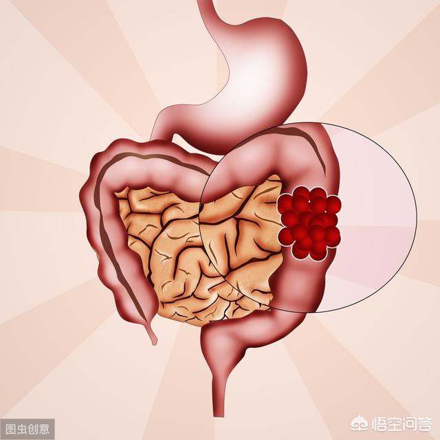 沒有便血沒有腹痛但大便不成形便溏是什麼原因