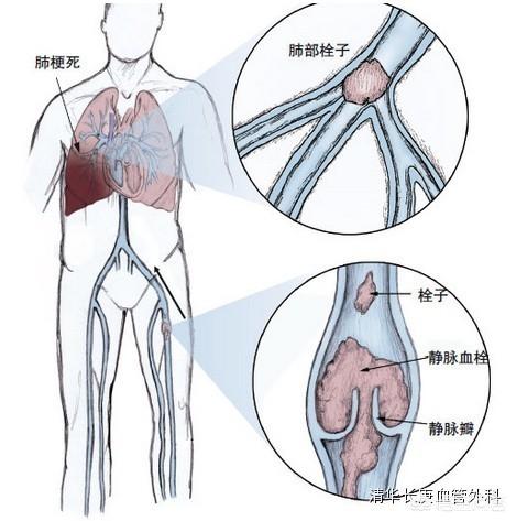老年人髋骨骨折的症状:髋骨骨折后怎样预防股骨头坏死？