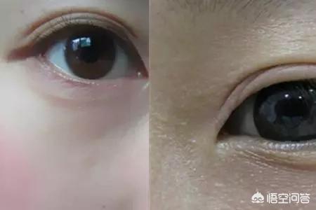希思黎瞬间紧致眼膜:眼皮皮肤松弛下垂了怎么办？