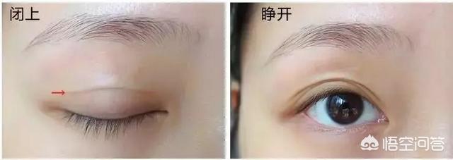 希思黎瞬间紧致眼膜:眼皮皮肤松弛下垂了怎么办？