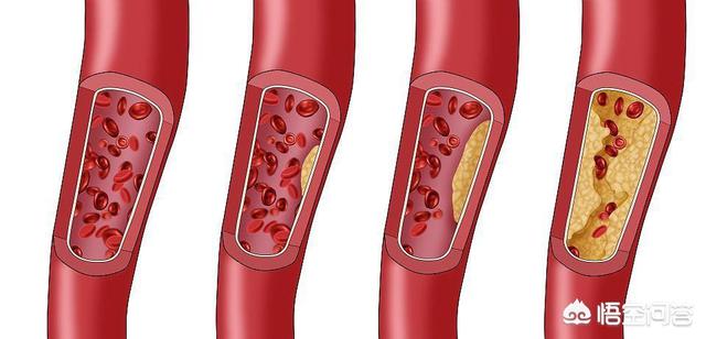頭條問答 - 心臟血管堵塞有什麼症狀?怎樣疏通血管?(30個回答)