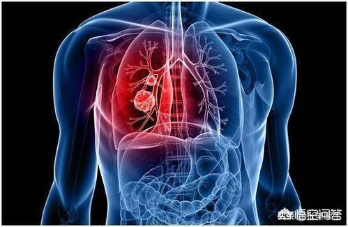 以胸痛为首发症状的肺癌大约可占到25%左右,肺癌类型的话以周围型