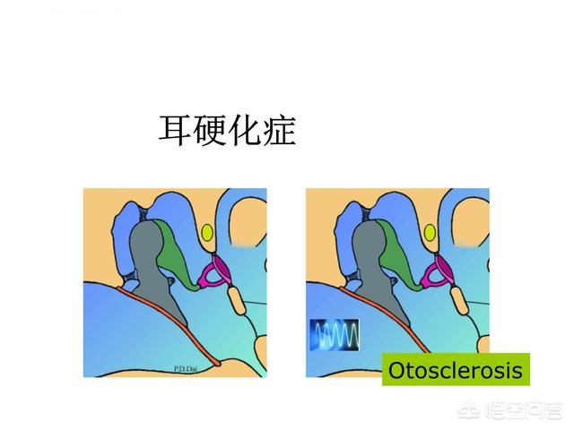 耳部结构图耳内骨迷路及膜迷路:耳硬化症和耳石症的区别是什么？