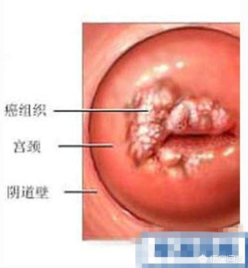 同房出血是什么原因造成的:产生同房出血是哪些原因引起的？