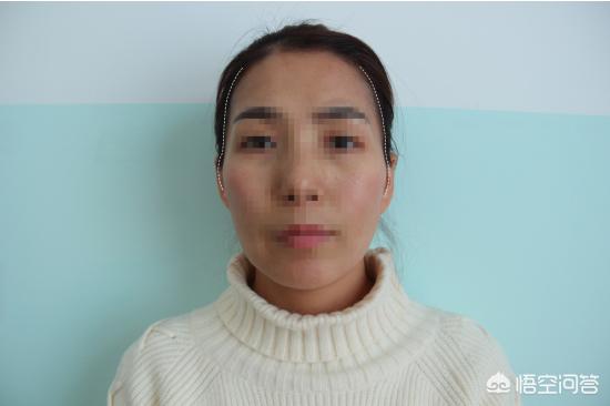 自体脂肪填充太阳穴能让额头变宽吗？