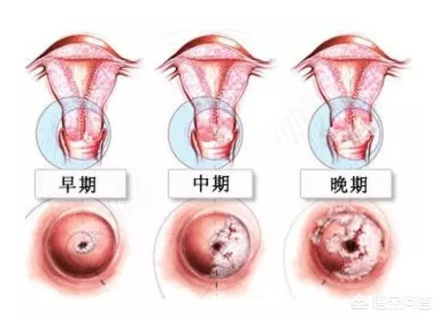 宫颈癌的六个信号图片图片