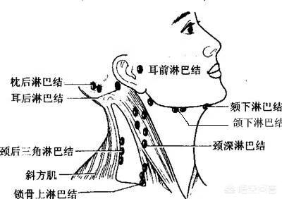 头条问答 - 颈部淋巴结节质地硬旁边还有几个小的是癌症吗?(1个回答)