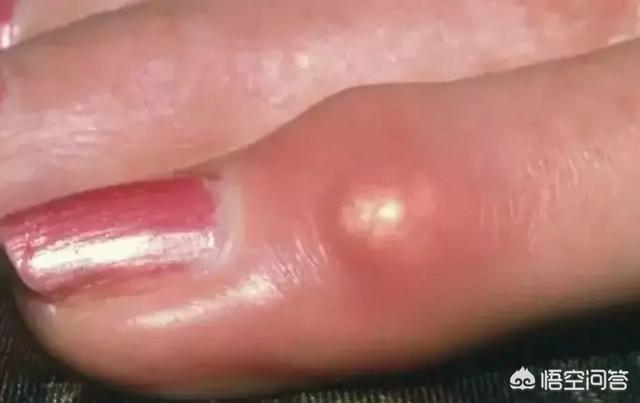 符晓薇:痛风“祸根”找到了，医生说：有3种食物要尽快远离，具体指什么