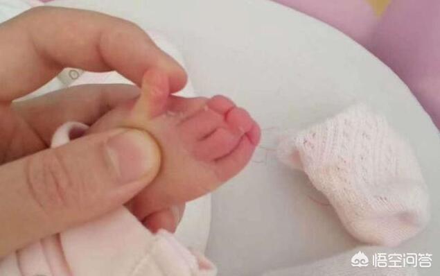 独眼畸形婴儿:产检正常，却生下畸形儿，到底怎么回事