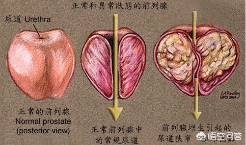 男性<a href=https://maguai.com/list/56-0-0.html target=_blank class=infotextkey>健康</a>日活动总结:男性如何守护前列腺<a href=https://maguai.com/list/56-0-0.html target=_blank class=infotextkey>健康</a>？