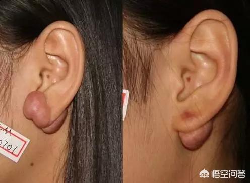 疤痕性体质(疤痕性体质是什么原因导致的)