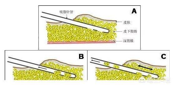 肌肉腿可以抽脂吗:做大腿吸脂的效果怎么样？