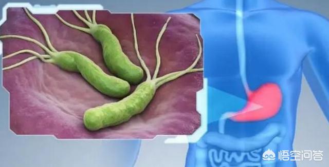 胃病的“克星”已发现,每天坚持吃,或能有效抑制“幽门螺杆菌”,胃病的克星是谁？