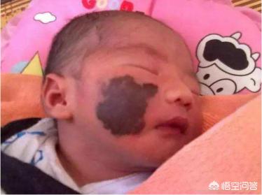 胎记的传说:怀孕期间肚子被打，撞，摔，碰真的会造成胎记吗？