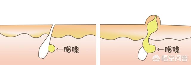 脂肪粒怎么消除在眼睛旁边的:眼周脂肪粒是怎么形成的？如何摆脱眼周脂肪粒的困扰？