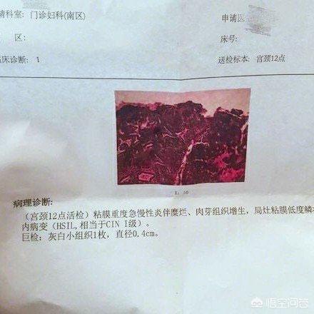 女性怎样增强自身免疫力:女性怎样增强自身免疫力 通过提高免疫力来清除HPV病毒需要做什么运动？