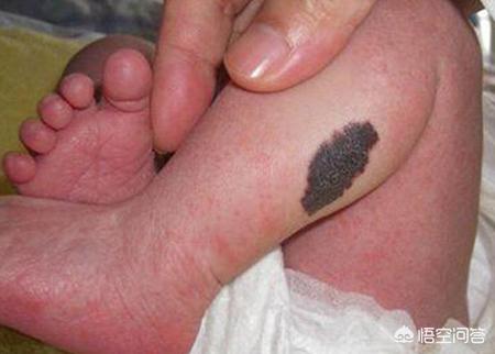 葡萄酒样痣，婴幼儿鲜红斑痣是普通胎记吗需要治疗吗