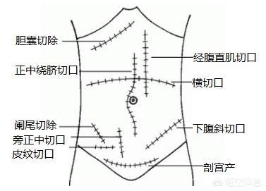 清创手术需要麻醉吗:脚部清创手术需要麻醉吗? 麻醉很痛吗？只是睡一觉吗？