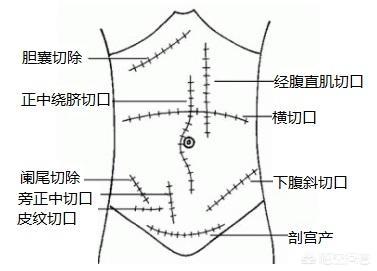 清创手术需要麻醉吗:骨科手术，可以不用麻药吗？