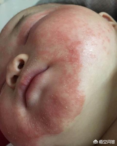 宝宝身上出现湿疹时，需要怎样护理？