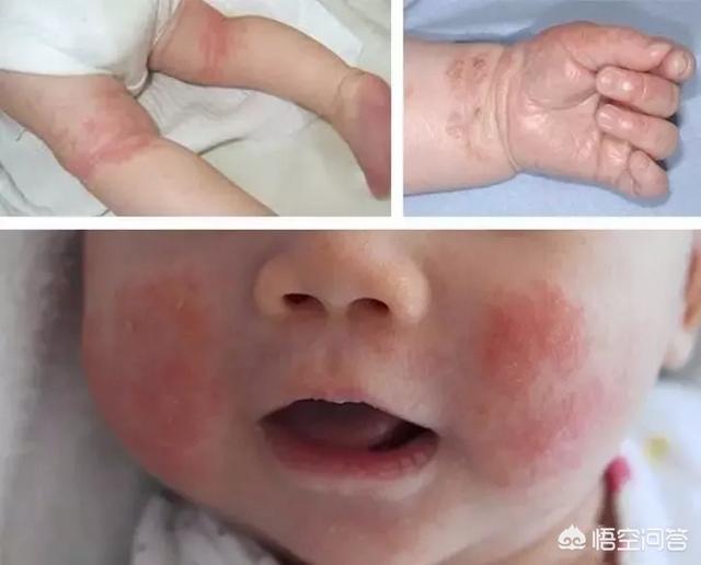 宝宝湿疹不盲目，了解原因最重要，如何避免是核心要素，是吗？