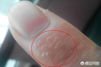 一到夏天手上出现小水泡,特别痒,怎么回事？