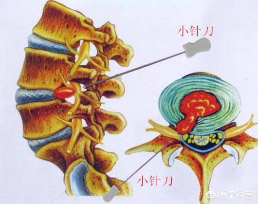 头条问答 - 小针刀对颈椎病有危害吗?(117个回答)